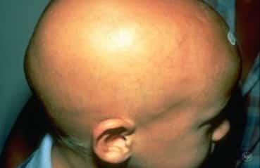 alopecia-areata-sac-dokulmesi