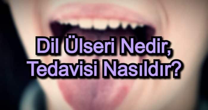 Dil Ülseri Nedir, Tedavisi Nasıldır?