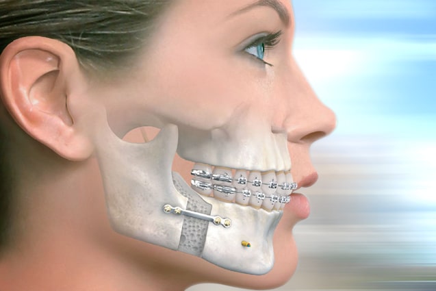 Ortodonti Ve Cene Cerrahisi Ayni Mi
